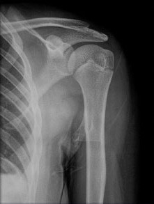 seattle slip and fall attorney