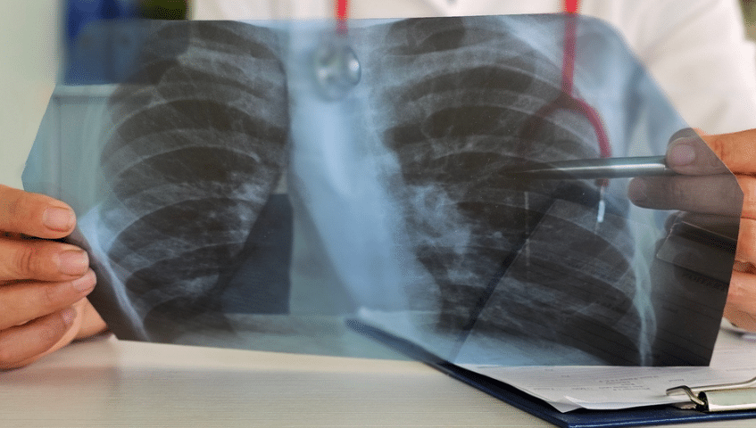 doctor reviewing a lung xray of a worker with an occupational illness