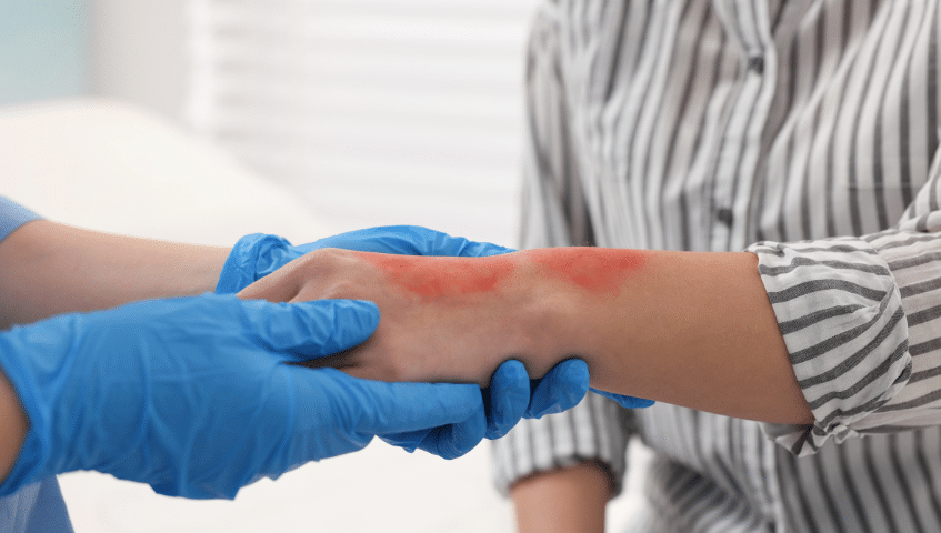 burn injury third-party claims